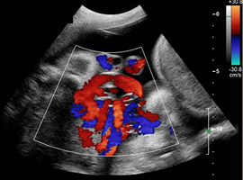 Twin Pregnancies Obstetric And Gynecology Ultrasound Curriculum